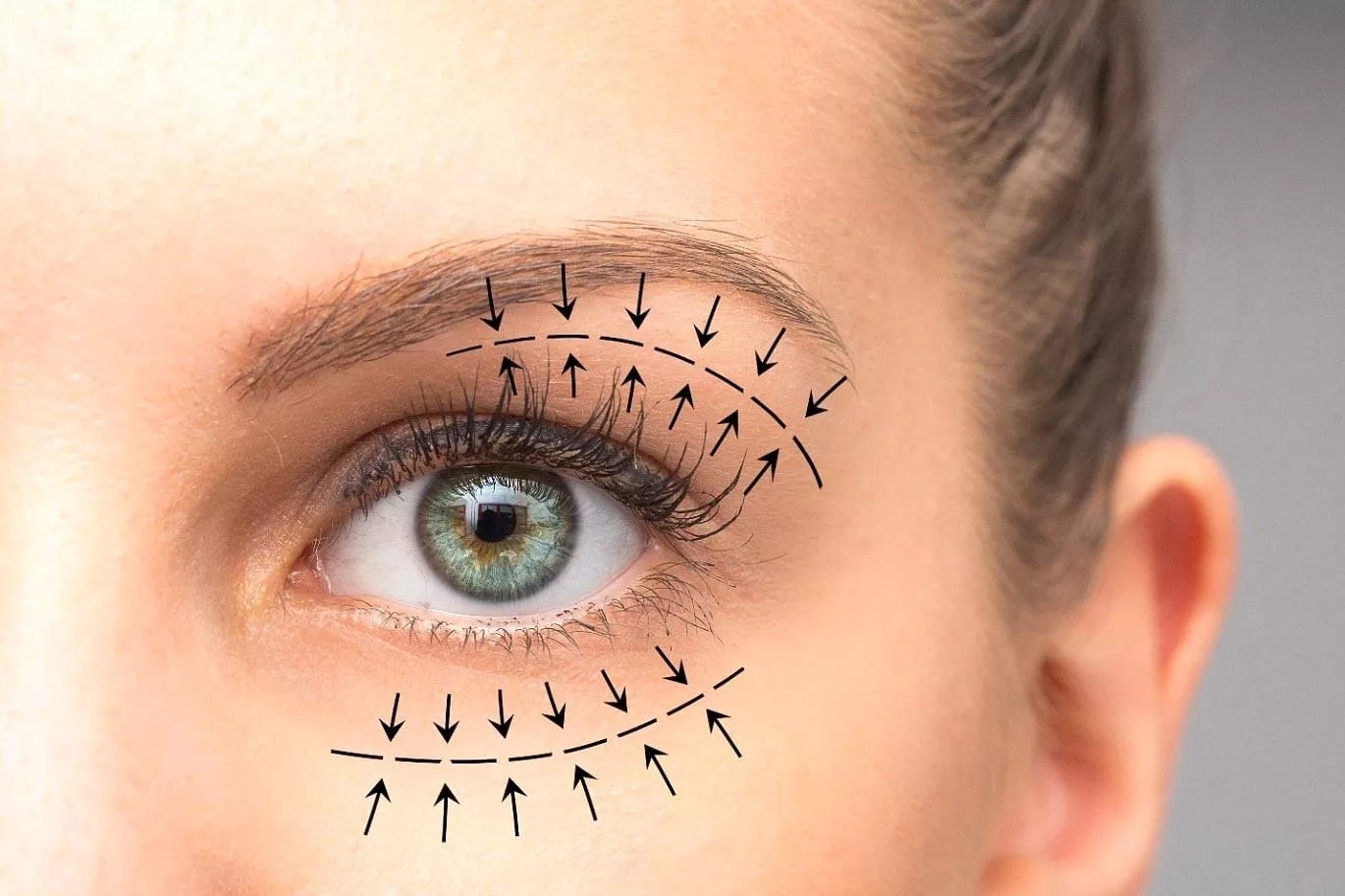 Blepharoplasty - A Complete Overview Of The Procedure